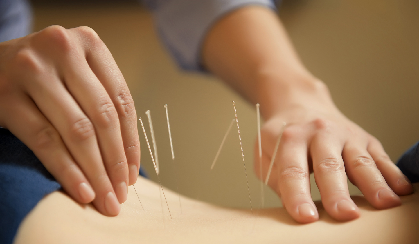 Hand gently putting acupuncture needles in patient's back And putting acupuncture needles in a patient's back.